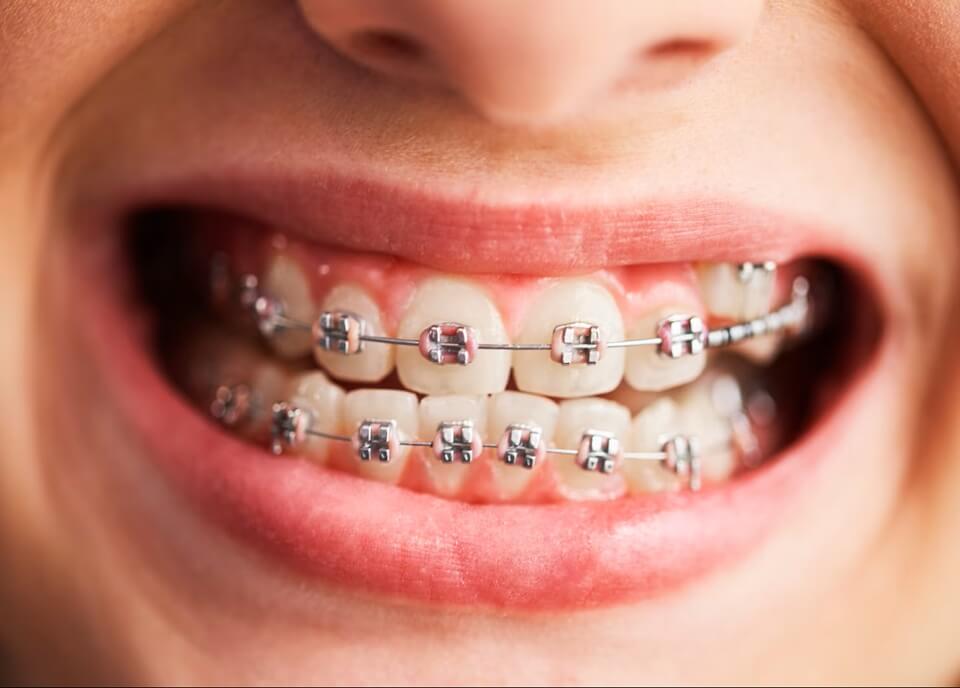 Orthodontic Braces Treatment