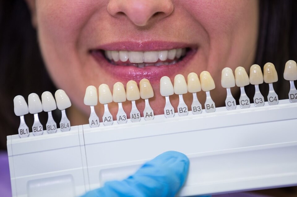 Dental Crowns and Veneers