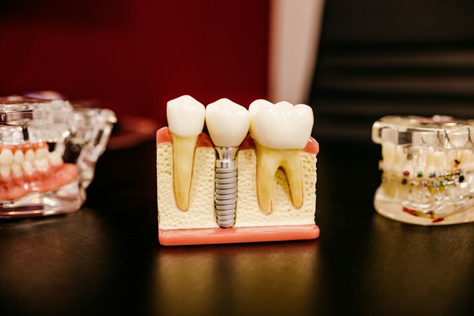 Dental Implant Procedure