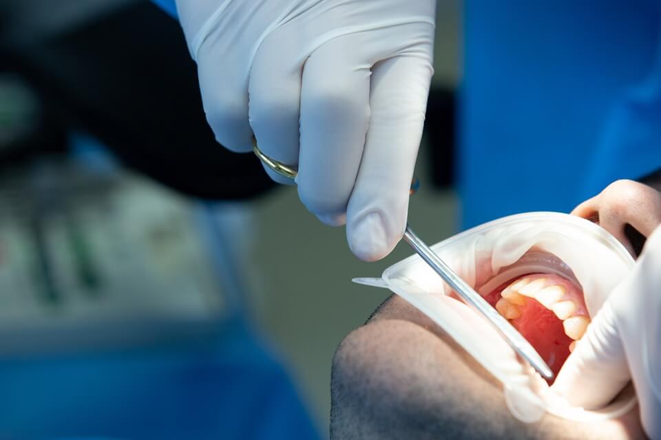 Tooth Extraction Procedure